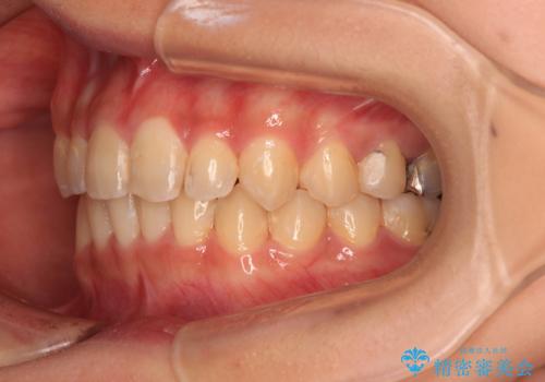 深い咬み合わせとデコボコの歯列をワイヤー矯正で改善の治療後