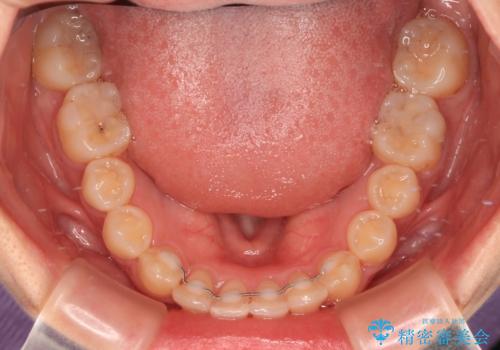 深い咬み合わせとデコボコの歯列をワイヤー矯正で改善の治療後