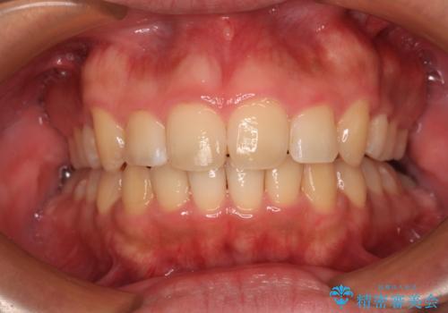 【モニター】後戻りで飛び出してきた前歯 ワイヤー装置での再矯正