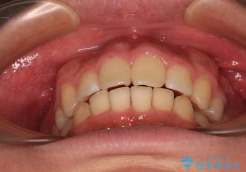 【モニター】後戻りで飛び出してきた前歯 ワイヤー装置での再矯正の治療後