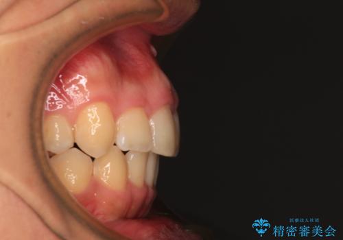 【モニター】後戻りで飛び出してきた前歯 ワイヤー装置での再矯正の治療後