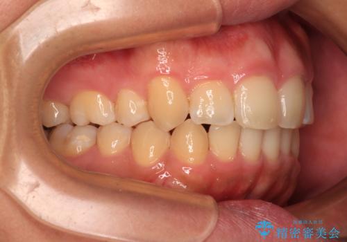 【モニター】後戻りで飛び出してきた前歯 ワイヤー装置での再矯正の治療後