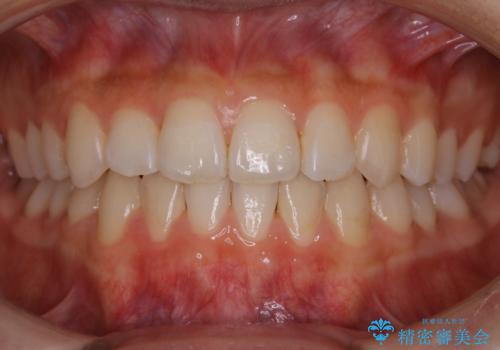 【非抜歯】受け口の改善　10代で始める本格的噛み合わせ治療の症例 治療後