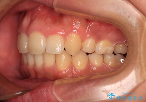 【モニター】後戻りで飛び出してきた前歯 ワイヤー装置での再矯正の治療後