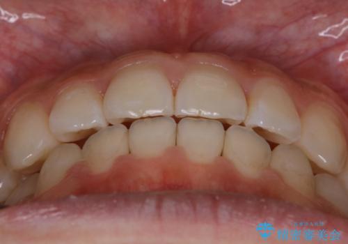 【非抜歯】受け口の改善　10代で始める本格的噛み合わせ治療の治療後