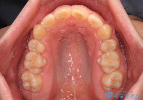 【モニター】後戻りで飛び出してきた前歯 ワイヤー装置での再矯正の治療後