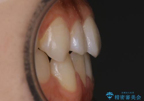 【非抜歯】受け口の改善 10代で始める本格的噛み合わせ治療の治療後