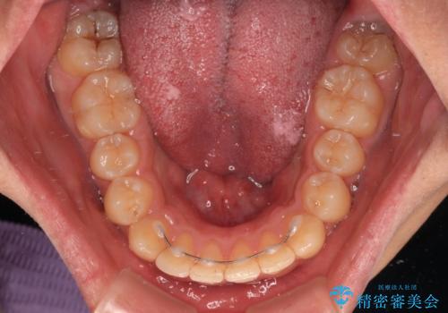 【モニター】後戻りで飛び出してきた前歯 ワイヤー装置での再矯正の治療後