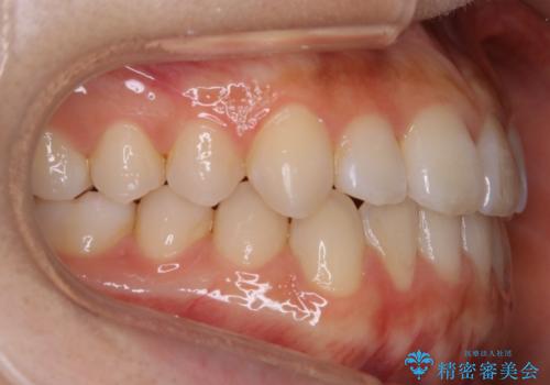 【非抜歯】受け口の改善 10代で始める本格的噛み合わせ治療の治療後