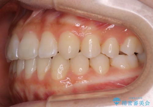 【非抜歯】受け口の改善 10代で始める本格的噛み合わせ治療の治療後