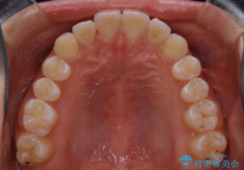 【非抜歯】受け口の改善 10代で始める本格的噛み合わせ治療の治療後