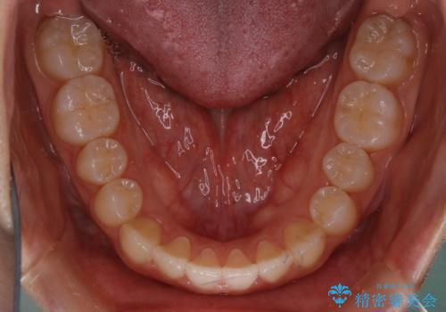 【非抜歯】受け口の改善 10代で始める本格的噛み合わせ治療の治療後