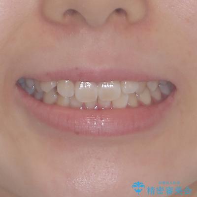 前歯のデコボコを整える インビザラインによる矯正治療の治療前(顔貌)