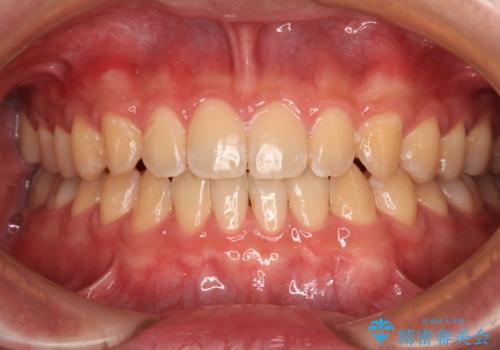 空隙歯列を閉じる 舌のトレーニングとワイヤー矯正の治療後