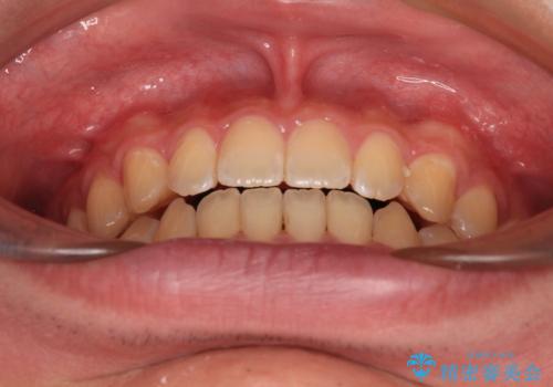 空隙歯列を閉じる　舌のトレーニングとワイヤー矯正の治療後