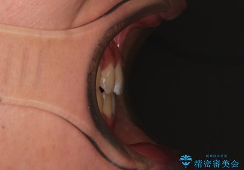 空隙歯列を閉じる 舌のトレーニングとワイヤー矯正の治療後