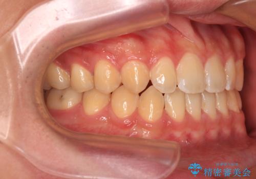 空隙歯列を閉じる 舌のトレーニングとワイヤー矯正の治療後
