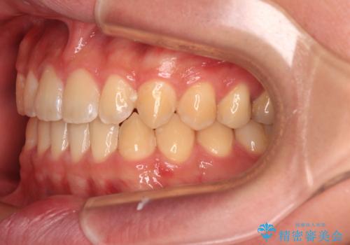 空隙歯列を閉じる 舌のトレーニングとワイヤー矯正の治療後