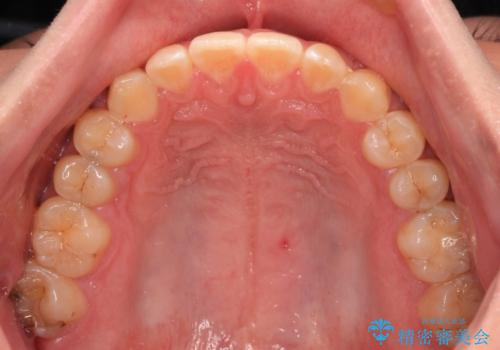 空隙歯列を閉じる 舌のトレーニングとワイヤー矯正の治療後