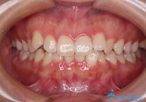 前歯のデコボコを整える　インビザラインによる矯正治療の症例 治療前