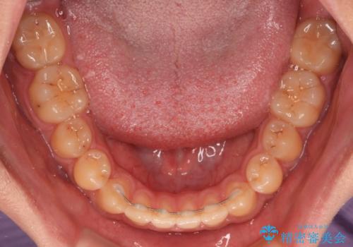 空隙歯列を閉じる 舌のトレーニングとワイヤー矯正の治療後