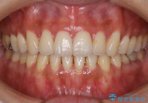 【非抜歯】歯を抜かなくても短期間でキレイな歯並びにの症例 治療後