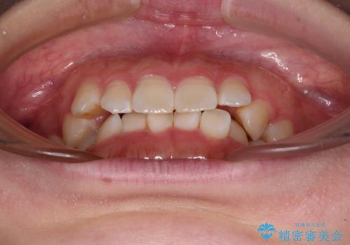 前歯のデコボコを整える インビザラインによる矯正治療の治療前