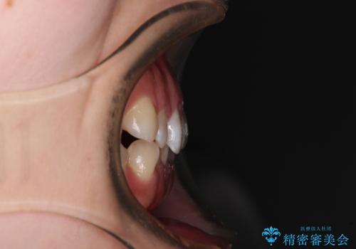 前歯のデコボコを整える インビザラインによる矯正治療の治療前