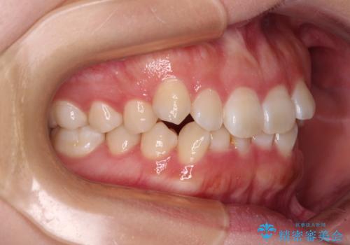 前歯のデコボコを整える　インビザラインによる矯正治療の治療前