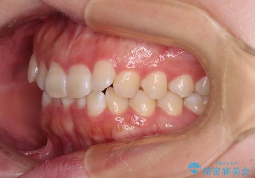 前歯のデコボコを整える インビザラインによる矯正治療の治療前