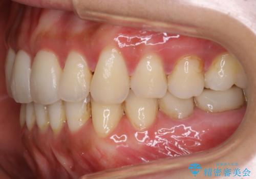 【非抜歯】歯を抜かなくても短期間でキレイな歯並びにの治療後