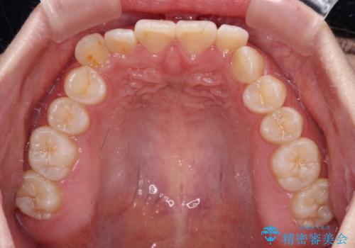 前歯のデコボコを整える　インビザラインによる矯正治療の治療前