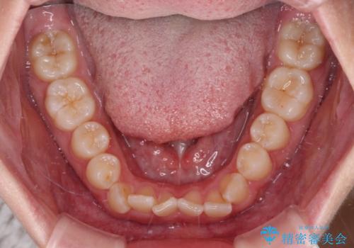 前歯のデコボコを整える インビザラインによる矯正治療の治療前