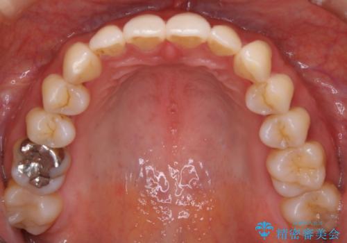 【非抜歯】歯を抜かなくても短期間でキレイな歯並びにの治療後