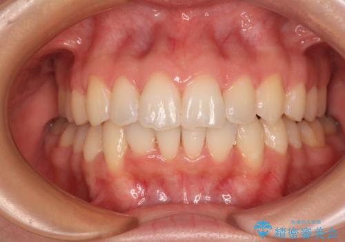【モニター】前歯のデコボコをインビザラインで改善の症例 治療後