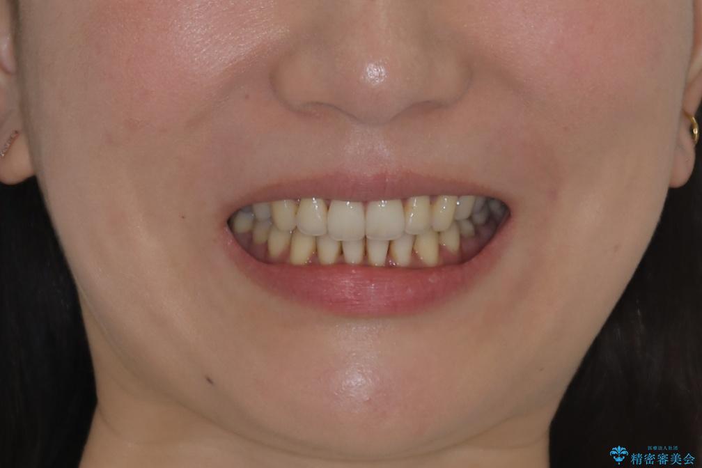 【非抜歯】歯を抜かなくても短期間でキレイな歯並びにの治療後（顔貌）