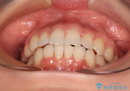 【モニター】前歯のデコボコをインビザラインで改善の治療後