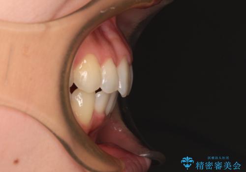 【モニター】前歯のデコボコをインビザラインで改善の治療後