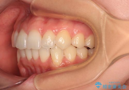 【モニター】前歯のデコボコをインビザラインで改善の治療後