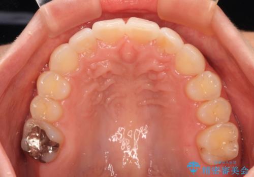 【モニター】前歯のデコボコをインビザラインで改善の治療後