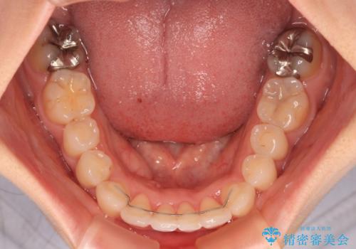 【モニター】前歯のデコボコをインビザラインで改善の治療後