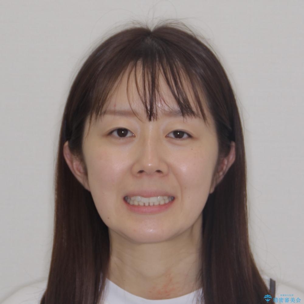 【モニター】前歯のデコボコをインビザラインで改善の治療後(顔貌)