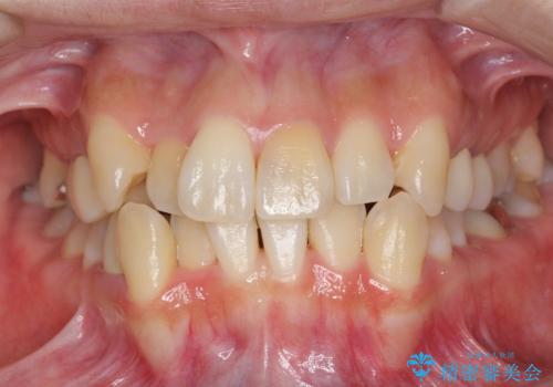 歯のがたつき　4本抜歯を回避してマウスピース矯正への症例 治療前