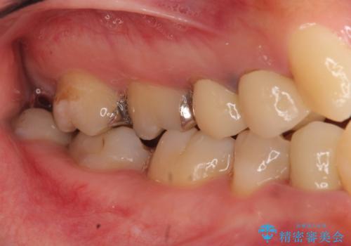 歯のがたつき　4本抜歯を回避してマウスピース矯正への治療前