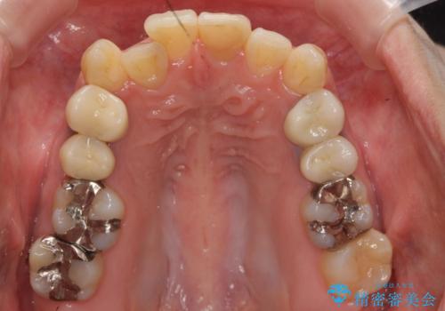 歯のがたつき　4本抜歯を回避してマウスピース矯正への治療前