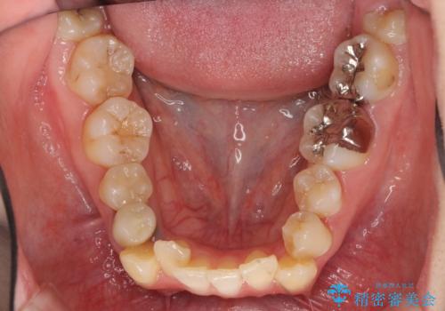 歯のがたつき 4本抜歯を回避してマウスピース矯正への治療前