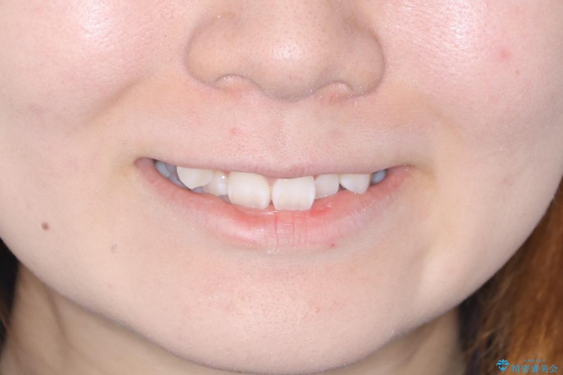 【抜歯】歯の先天欠如　歯の本数が上下で違う場合の治療の治療前（顔貌）