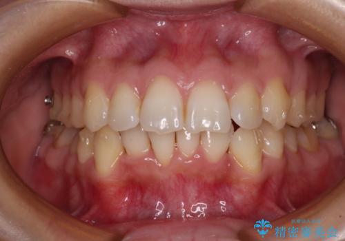 【モニター】前歯のデコボコをインビザラインで改善の治療中