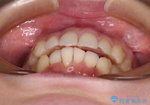 【モニター】前歯のデコボコをインビザラインで改善の治療中