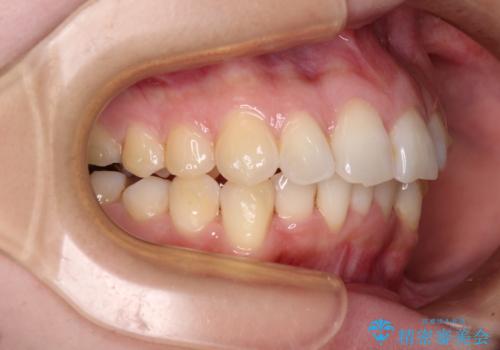 【モニター】前歯のデコボコをインビザラインで改善の治療中